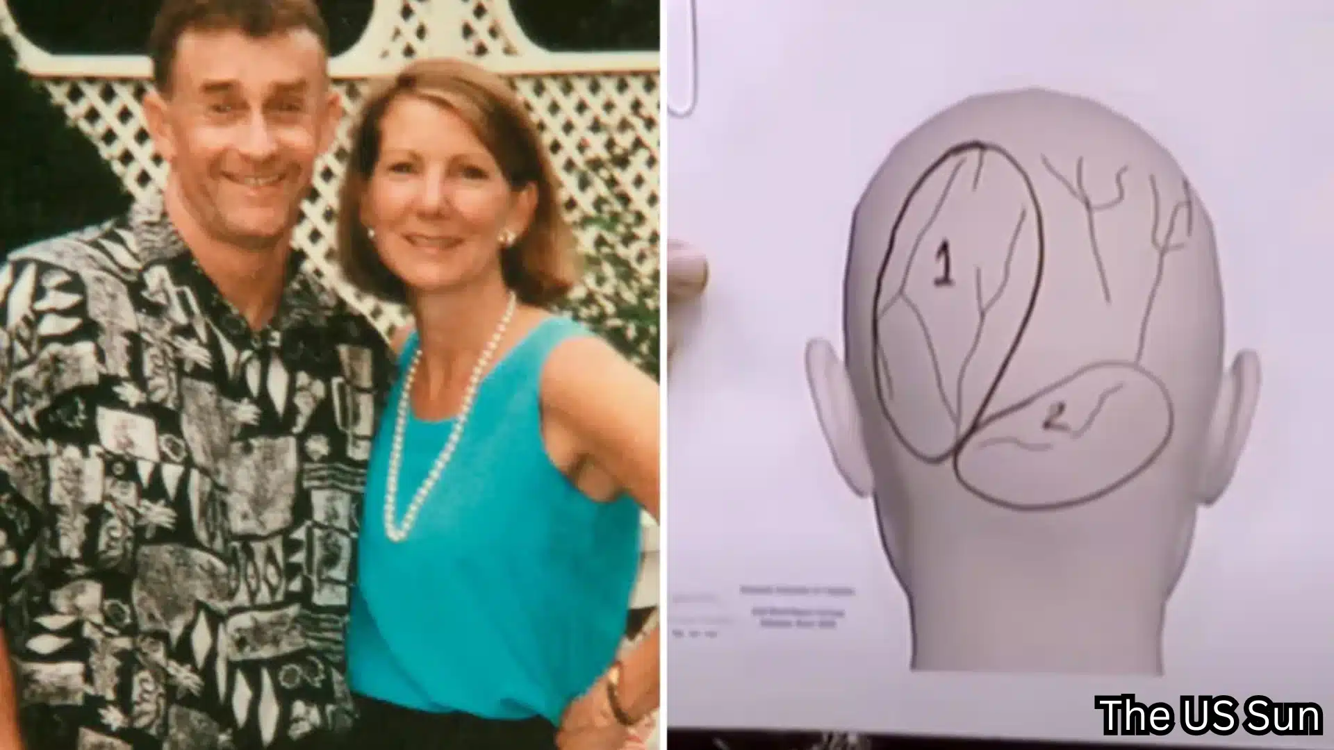 Michael and Kathleen Peterson beside a courtroom diagram showing Kathleen Peterson’s head injuries.